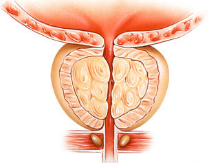 Medical illustration showing a cross sectional enlargement of the prostate gland