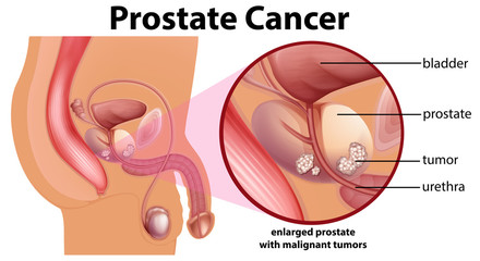 Medical illustration showing the anatomy of a male including bladder, prostate and urethra with an inset showing an enlarged prostate with malignant tumours